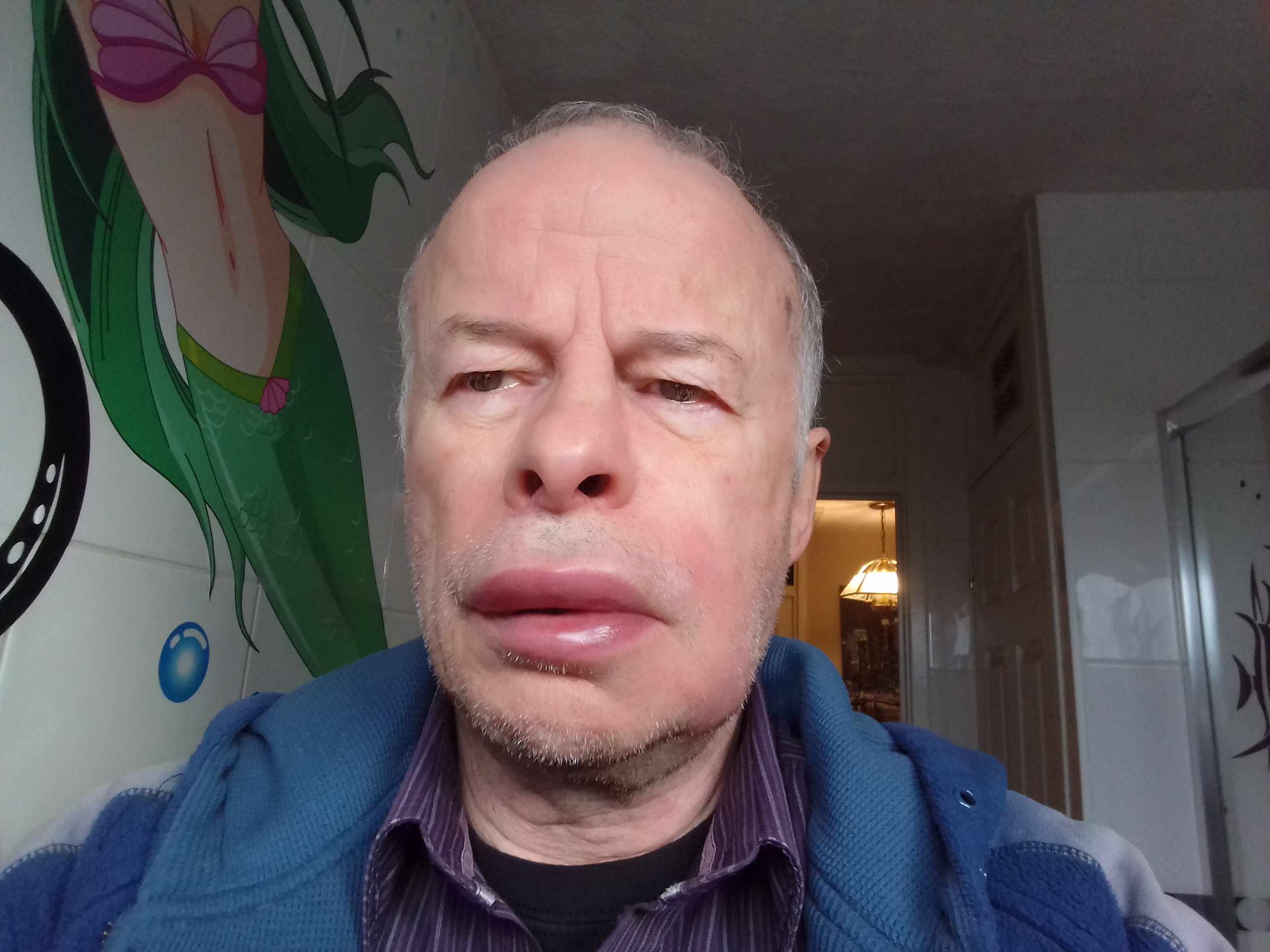 21 WTN 2019-12 Nigel Allen allergy lips.jpg